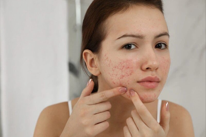 Da mặt dị ứng là phản ứng khi tiếp xúc với các chất gây kích ứng
